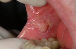 F18: Buccal mucosa cancer