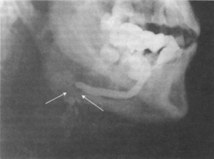 Sialogram of the submandibular salivary gland – obstruction due to stone noted