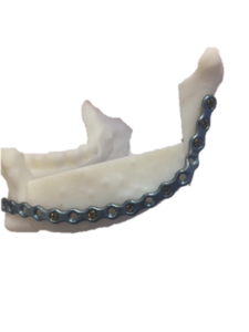 F19: LEFT mandible SCC: Resection and reconstruction using 3D printer, Proplan and patient specific PSP guides: The 3D model and the PSP plate