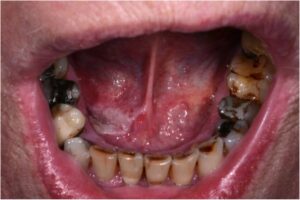 F19: Early floor of the mouth cancer presenting as an area of irregular leukoplakia (white patch)