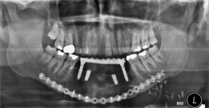 F19: OPG image of anterior mandible reconstruction with DCIA free flap and osseointegrated dental implants (final)