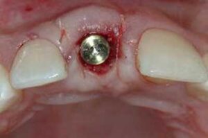 F2: Upper central incisor dental implant