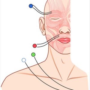 Schematic representation of intraoperative facial nerve monitoring during a parotidectomy procedure