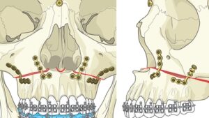 F2: LeFort I maxillary osteotomy – maxilla advanced in new position