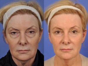 F2: Pre (LEFT) and post (RIGHT) upper and lower blepharoplasties