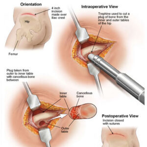 F2: Schematic representation of harvest of iliac crest autologous bone graft with the aid of trephine