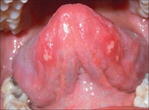 F2: Typical apthous ulcers on the ventral surface of the tongue