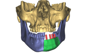 F2: LEFT mandible ameloblastoma. Resection and reconstruction using 3D printer, Proplan and patient specific PSP guides: The predicted final result