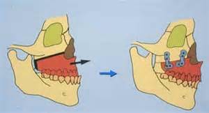 F2: LeFort I maxillary osteotomy – maxilla advanced in new position