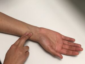 F2: Allen’s test: Palpate the radial artery and ensure there is good pulse