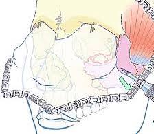 F2: The coronal flap for access to the midface: Schematic representation