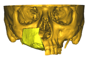 F20: RIGHT maxillary SCC: Resection and reconstruction using 3D printer, Proplan and patient specific PSP guides: Overview