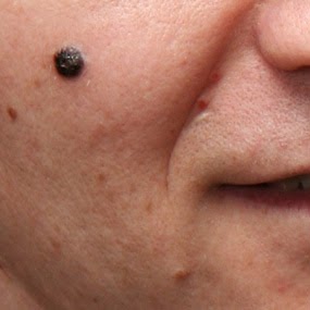 F20: Cutaneous melanoma on the cheek