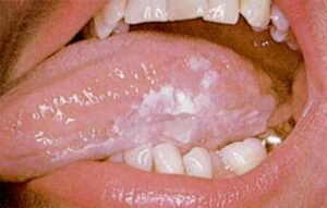 F20: Early tongue cancer presenting as an area of irregular leukoplakia (white patch)