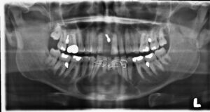 F20: Glandular epithelial odontogenic cyst, causing pathological fracture of the anterior mandible and requiring segmental resection