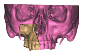 F21: RIGHT maxillary SCC: Resection and reconstruction using 3D printer, Proplan and patient specific PSP guides: Overview