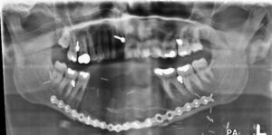 F21: OPG image of anterior mandible reconstruction with DCIA free flap