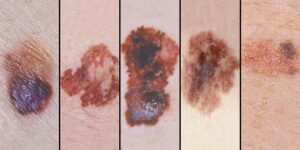 F21: Dermoscopic appearance of cutaneous melanoma