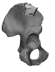 F22: RIGHT maxillary SCC: Resection and reconstruction using 3D printer, Proplan and patient specific PSP guides: The guide for the DCIA free flap