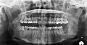 F22: OPG image of odontogenic myxoma of the LEFT angle of the mandible requiring segmental resection