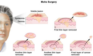 F23: Schematic representation of the principles of Mohs micrographic surgery