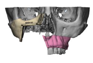 F23: RIGHT maxillary SCC: Resection and reconstruction using 3D printer, Proplan and patient specific PSP guides: The guides for the tumour resection