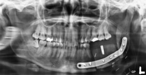 F23: OPG image of LEFT angle of the mandible reconstruction with DCIA free flap and osseointegrated dental implant