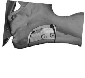 F24: RIGHT maxillary SCC: Resection and reconstruction using 3D printer, Proplan and patient specific PSP guides: The guide for the osseointegrated dental implants