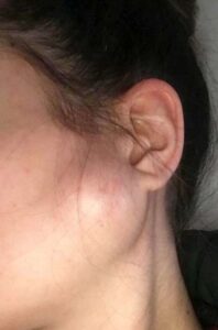 F24: Parotid lump