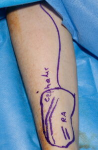 F24: Radial forearm free flap harvesting: Marking of anatomical landmarks and flap outline