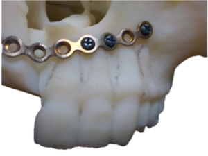 F25: RIGHT maxillary SCC: Resection and reconstruction using 3D printer, Proplan and patient specific PSP guides: The PSP plate