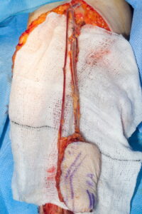 F25: Radial forearm free flap harvesting: Full dissection of the vascular pedicle