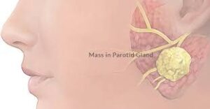 F25: Parotid lump – schematic, showing the relation of the lump to the facial nerve