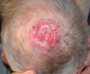 F25: Large cutaneous SCC of the scalp