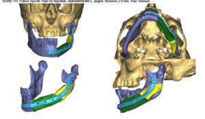 F26: LEFT mandible SCC: Resection and reconstruction using 3D printer, Proplan and patient specific PSP guides: Overview