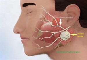 F26: Parotid lump – schematic, showing the relation of the lump to the facial nerve