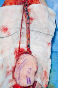 F27: Radial forearm free flap harvesting: Vascular pedicle marked and ready to detach