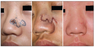 F27: Bi-lobed transposition flap for nasal reconstruction