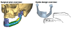 F28: LEFT mandible SCC: Resection and reconstruction using 3D printer, Proplan and patient specific PSP guides: The predicted final result