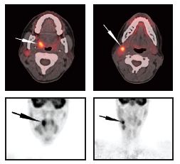 F28: PET CT image of tonsilar cancer with spread to the ipsilateral lymph nodes