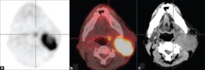 F29: PET CT image of very small tonsilar primary cancer with very advanced neck metastatic disease