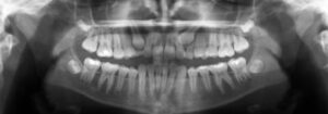 F3: OPG image of impacted maxillary canines