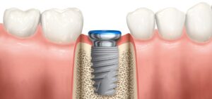 F3: Single mandibular dental implant - schematic