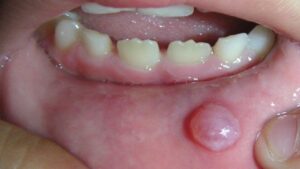 F3: Lower lip mucocele