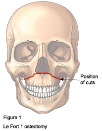 F3: LeFort I maxillary osteotomy – schematic representation of the bony cuts