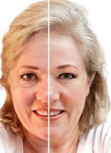 F3: Pre (LEFT) and post (RIGHT) upper and lower blepharoplasties