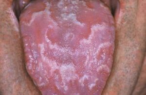 F3: Geographic tongue