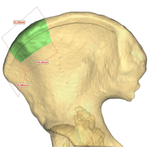 F3: LEFT mandible ameloblastoma. Resection and reconstruction using 3D printer, Proplan and patient specific PSP guides: The planned required bony segment for the DCIA free flap