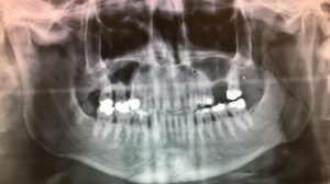 F3: OPG image of RIGHT parasymphysis and LEFT ramous mandible fracture