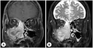 F30: MRI image of sinus cancer